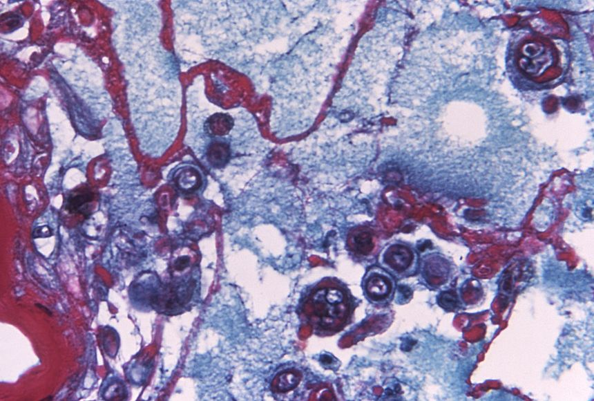 This photomicrograph shows some of the changes visible in human tissue infected with the varicella zoster virus.